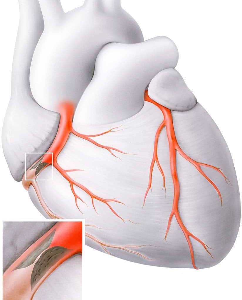 Tratament naturist pentru Angor intricat - dureri cauzate de muschiul cardiac 9 Angor intricat
