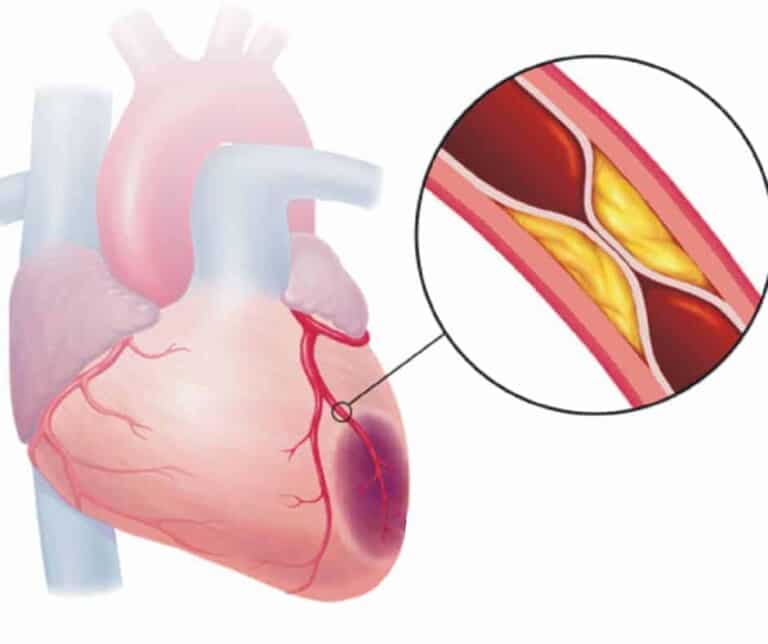 Cardiopatia ischemica se vindeca? Terapii naturiste adjuvante cu produsele Calivita 6 Cardiopatia ischemica se vindeca? Terapii naturiste adjuvante cu produsele Calivita