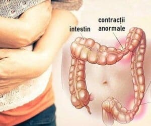 Remedii naturiste pentru sindromul de colon iritabil cu produsele Calivita 9 colon iritabil tratament naturist